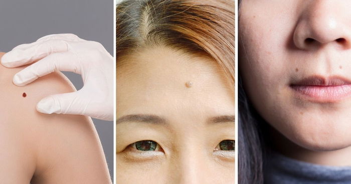 You Are Considered Really Lucky If You Have Moles On These 8 Body Parts