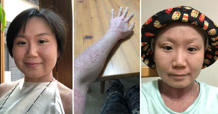 'I Know What I'm Meant To Do In This Life': 28-Year-Old Finds Her Calling Through Debilitating Skin Condition