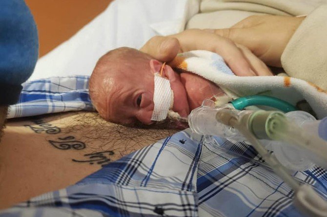 premature baby health issues