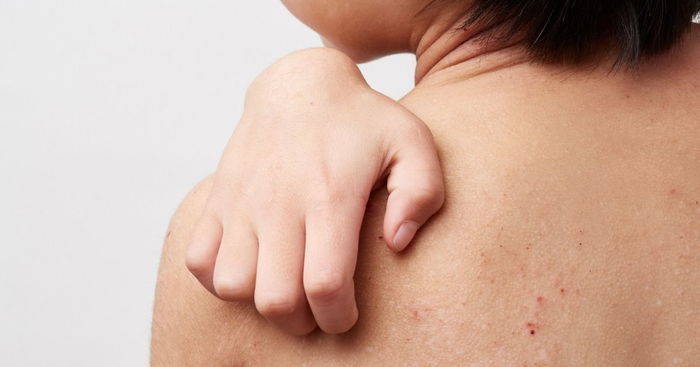 Atopic Dermatitis: Here's How Parents Can Take Care Of Kids With This Condition
