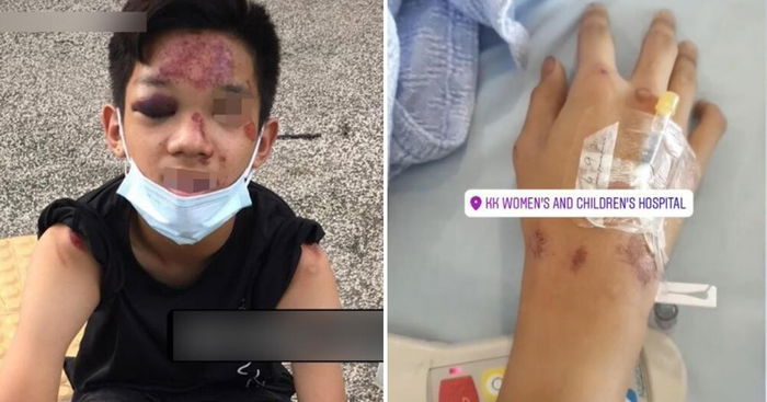14-Year-Old Cyclist Badly Injured After Being Hit By Car, Driver Allegedly Just Drove Off