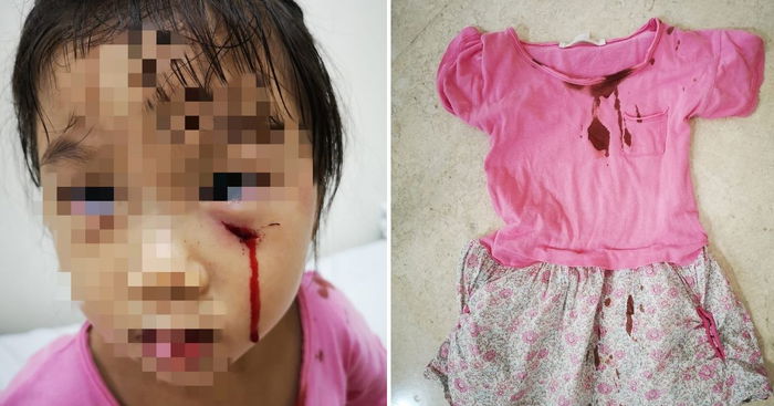 Peacock Attacks 3YO Girl Near Serangoon Gardens, Leaves Her With A Deep Cut On Her Face