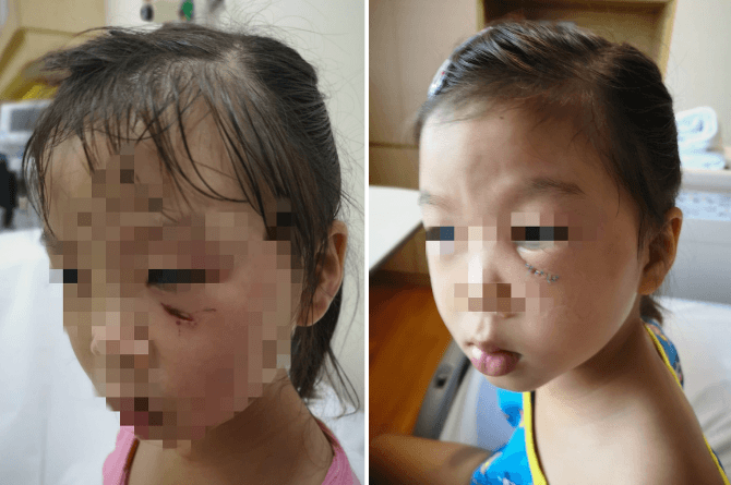 Peacock Attacks 3YO Girl Near Serangoon Gardens, Leaves Her With A Deep Cut On Her Face