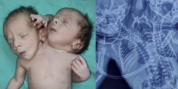 Mum in India Gave Birth to A Baby with Two Heads and Three Hands