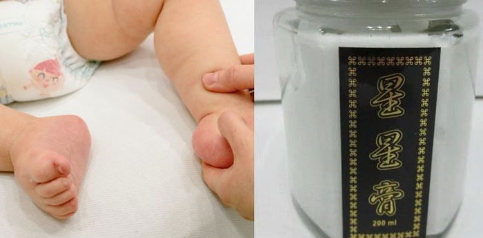 ‘I Was Giving My Son Poison’: Baby Suffered From Abnormal Eye Alignment, Bulging Head After Using Cream Introduced by Confinement Lady