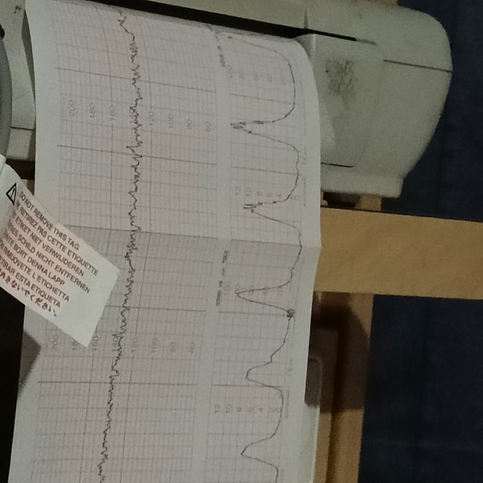 My birth story of Baby Ron