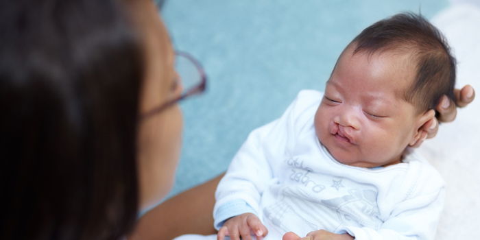 Cleft Palate: Everything You Need To Know About This Birth Defect in Babies