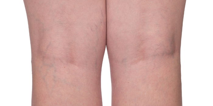 Pregnancy and Varicose Veins: Understanding the Unwanted Guests