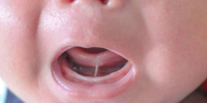 Tongue Tie In Babies: How To Check For Symptoms And Treatment For This Condition