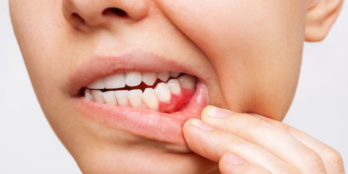 5 Things You Need to Know About Bleeding Gums During Pregnancy