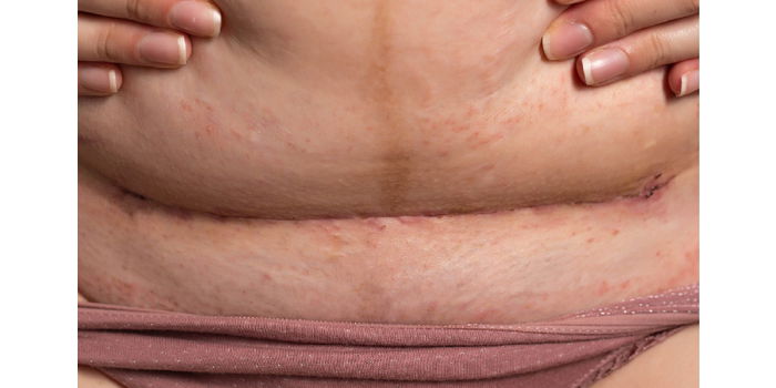 Caesarean Section Recovery: Caring for Your Stitches Post-Treatment