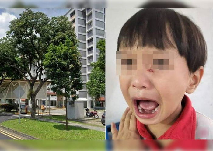 Boy, 2, Suffers Cut On Face After Getting Knocked Down By Delivery Rider; Mum Worries Scar May Be Permanent