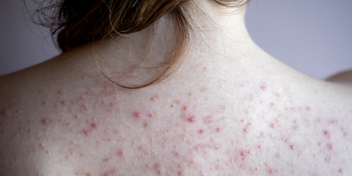 Bacne Treatment: Unveiling Clear Skin Secrets