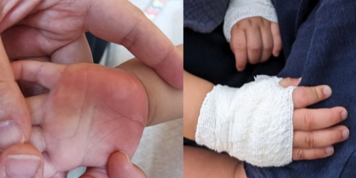 Mum Accuses Preschool of Negligence After 11-Month-Old Boy Burns Hands on Hot Surface