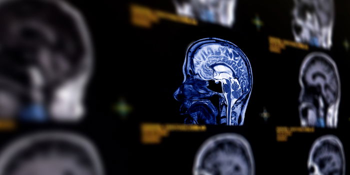 Effects of Removing Both Ovaries on Brain Health: What You Need to Know