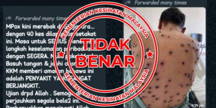 Viral WhatsApp Message on Mpox Outbreak in Singapore Proven as Fake News