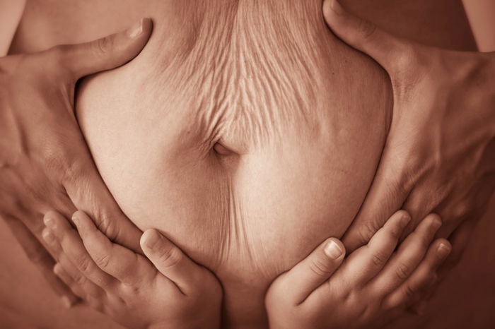 10 Proven Ways to Effectively Reduce Stretch Marks