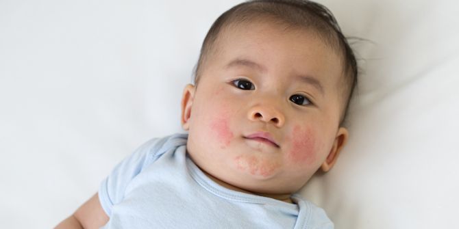 Top 17 Eczema Creams for Babies and Kids in Singapore: Gentle, Safe, and Effective Solutions