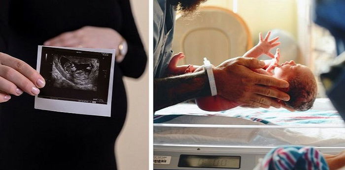 Duodenal Atresia: Causes, Symptoms, Diagnosis, Treatment