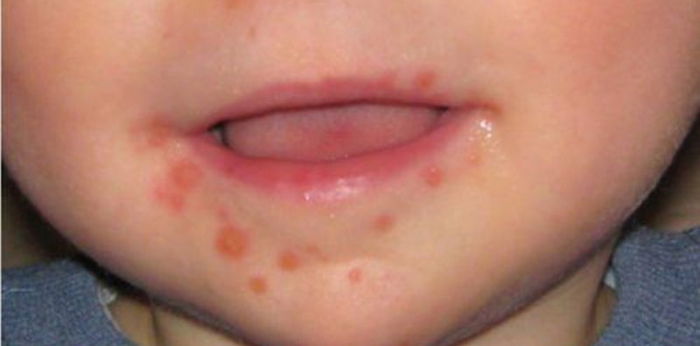 Singapore Flu: Causes, Symptoms, Transmission Process, Treatment