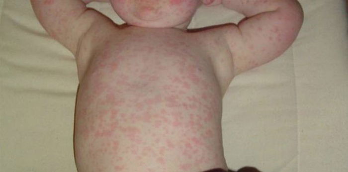 Roseola Infantum in Babies: Symptoms, Causes, How to Treat