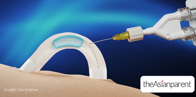 ADAM: New Male Contraceptive Implant Offers Hormone-Free, Reversible Birth Control That Lasts Two Years