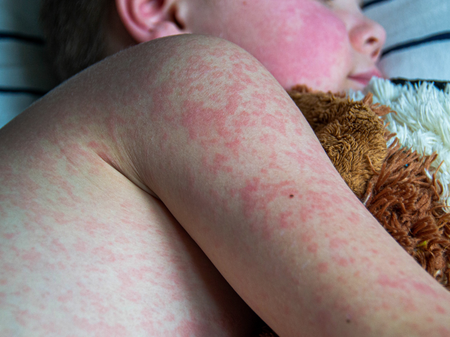 measles outbreak