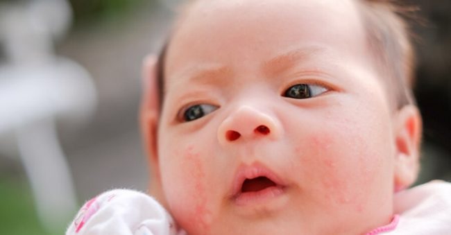 20 Types of Skin Rashes in Babies, Causes and How to Treat them