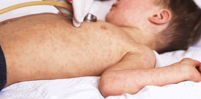 Measles: Causes, symptoms and treatment for German measles or Rubella