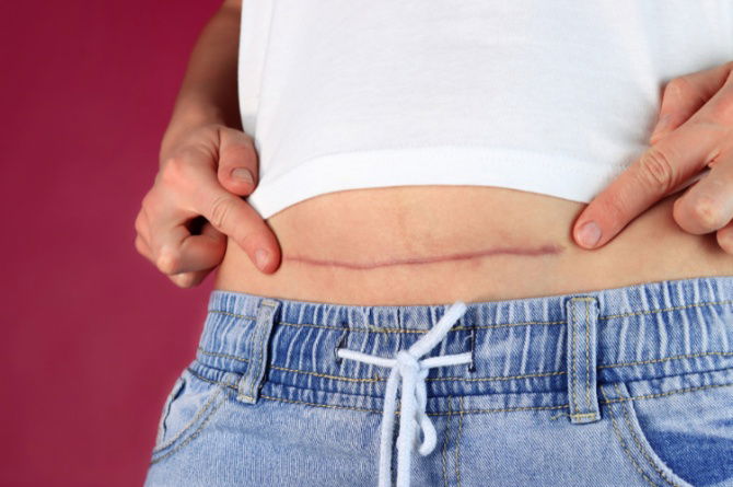 Open Czer Wounds, Mothers Need to Know! These Are 7 Causes and How to Treat Them