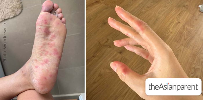 Childbirth Was Painful, But Catching HFMD From Her Baby Was Worse