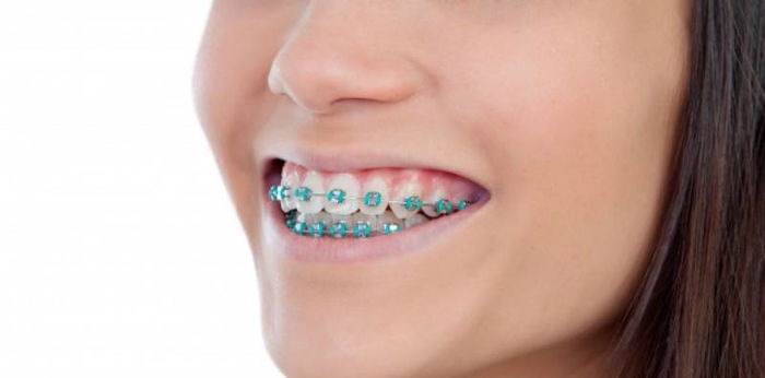 Is it dangerous for pregnant women to wear braces? Here are the disadvantages and benefits.
