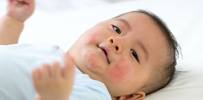Get to Know Erythema Toxicum Neonatorum: Causes, Symptoms, and Treatment