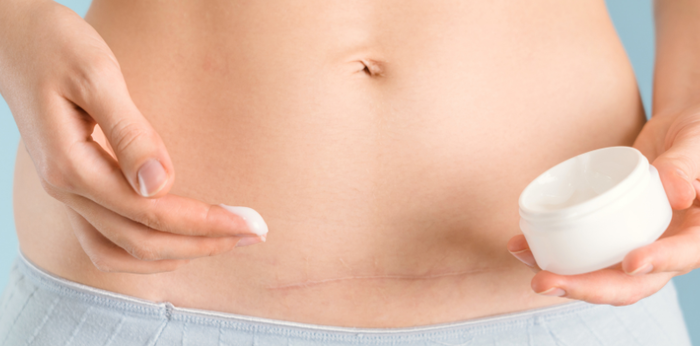 Scar reduction medication for mothers who have had a cesarean section. Which type won't cause keloids?