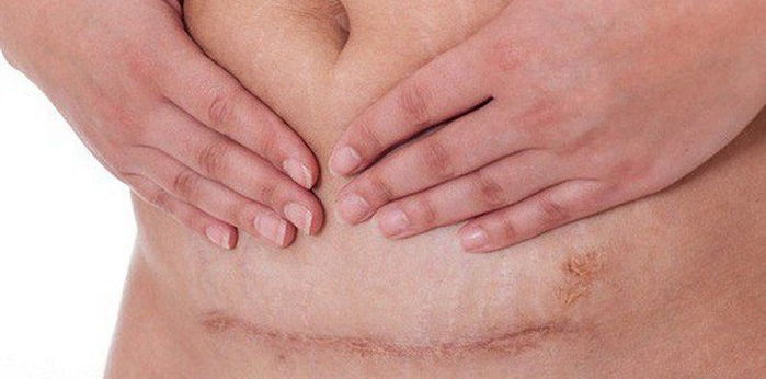 Cách chăm sóc vết mổ sau sinh giúp mẹ giảm đau và hồi phục nhanh chóng