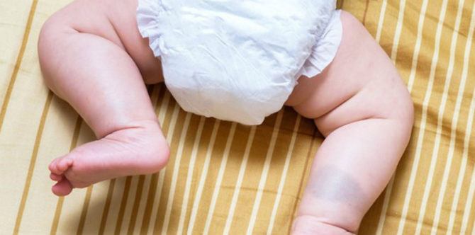 Jadi Keunikan Tersendiri, Ketahui Jenis Tanda Lahir pada Bayi dan Ciri yang Berbahaya