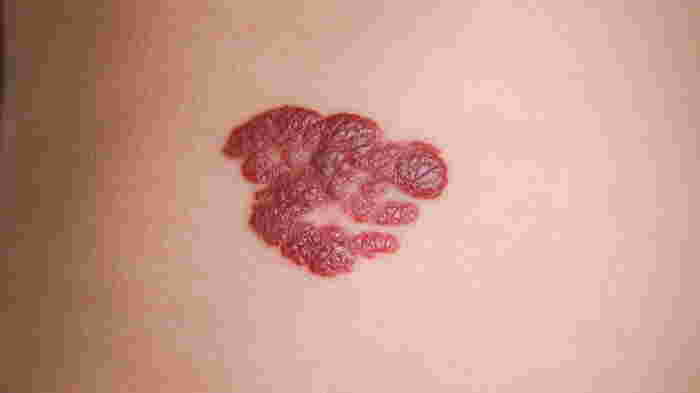 ini Hemangioma Bisakah Disembuhkan