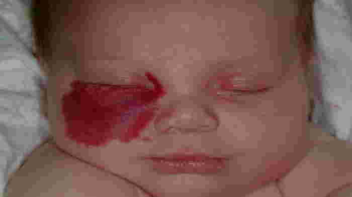 ini bercak merah pada kulit bayi hemangioma
