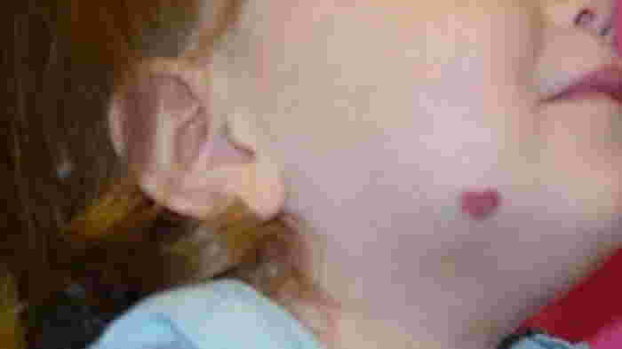 ini hemangioma pada anak apakah berbahaya