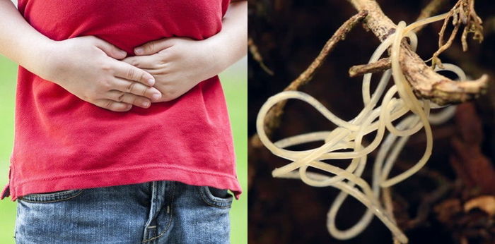 Cacing Kremi pada Anak: Penyebab, Tanda Infeksi, Penanganan