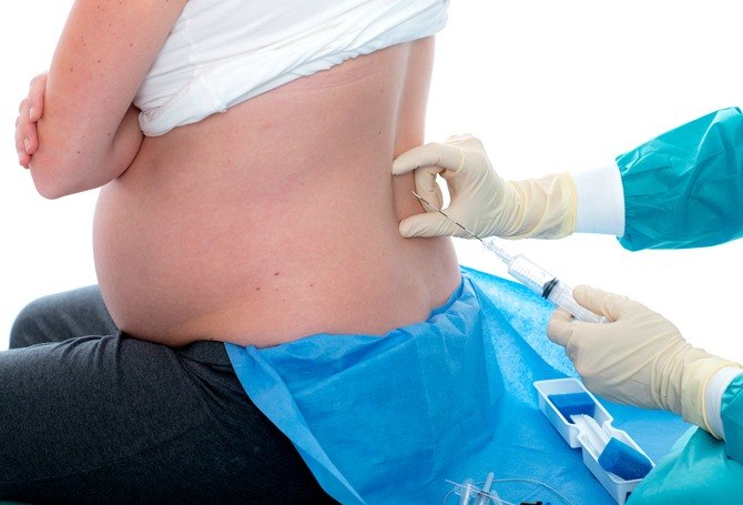 Manfaat dan Risiko Prosedur Anestesi Epidural saat Melahirkan