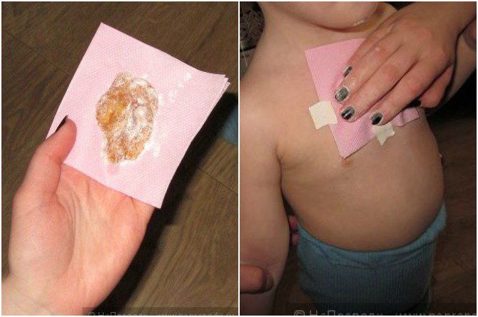 Benarkah Kompres Madu Dapat Meredakan Batuk Berdahak pada Anak