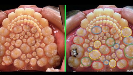 tau hyperdontia ini 232 gigi