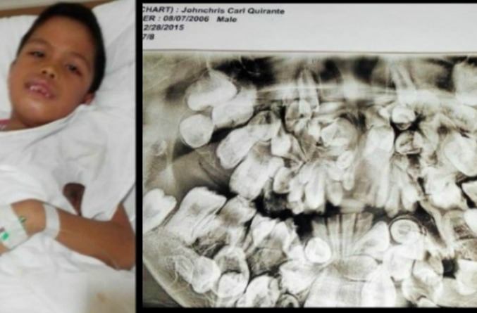 Hyperdontia, Anak 9 tahun Punya 300 Gigi