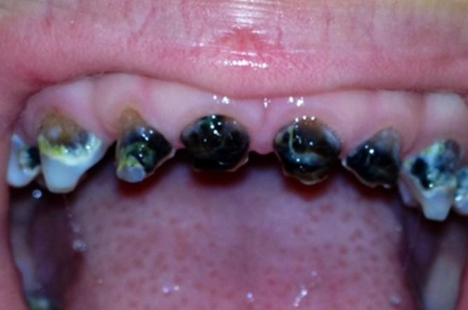 Gigi Gigis pada Anak Akibat Menyusu Sambil Tidur, Ini Cara Mengobati dan Pencegahannya