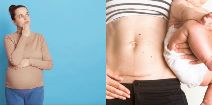 Berapakah Jarak Kehamilan yang Aman Setelah Operasi Caesar?