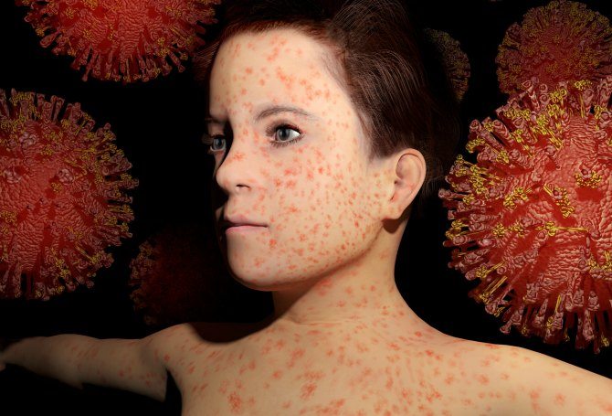 Waspadai Rubella (Campak Jerman) Pada Ibu Hamil dan Anak-anak