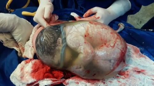Sungguh Menakjubkan, Bayi Ini Lahir Lengkap dengan Kantung Ketuban!