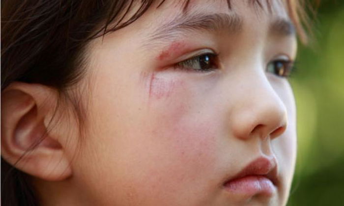 Anak Terjatuh Hingga Memar? Jangan Diurut Ya, Bunda!