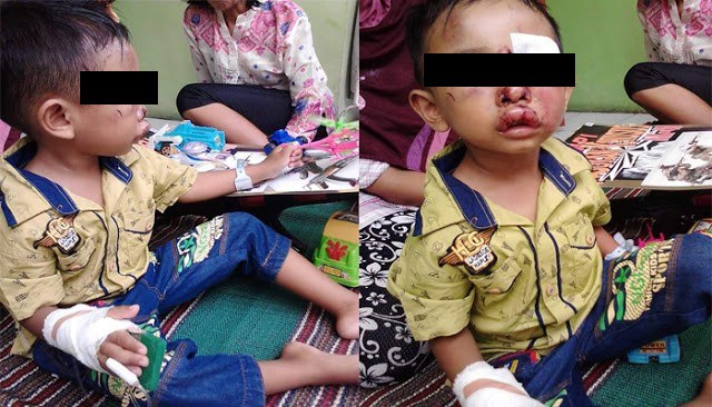 Siswa PAUD di Wates Babak Belur Dihajar Kakak Kelas